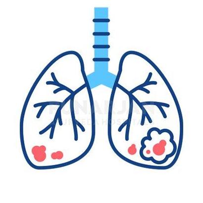 Lungcancer