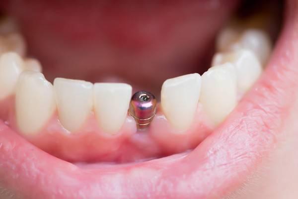  dental implants Gosport 