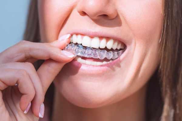 invisalign Kirkcaldy