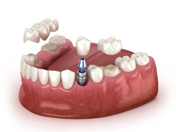  dental implant Swansea