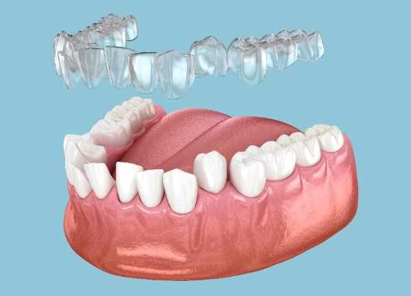 Invisalign Wigan