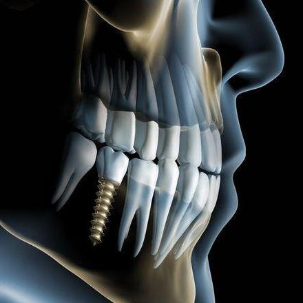 dentalimplantsnottingham